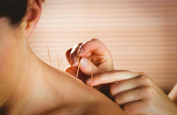Điện mãng châm điều trị rối loạn thần kinh chức năng sau chấn thương sọ não